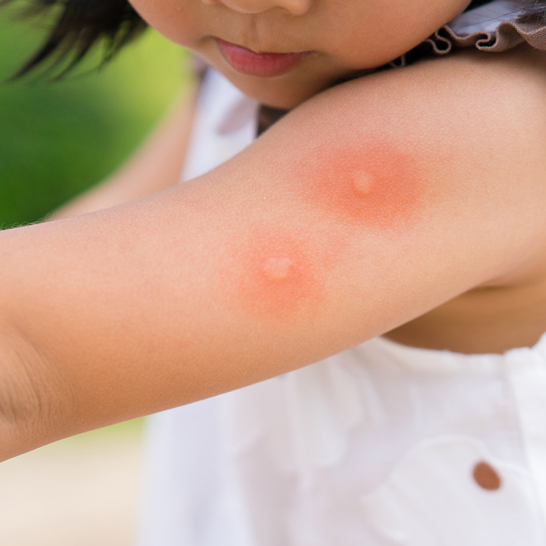 Insect Bite Wipes available in online  pharmacy qatar, doha 